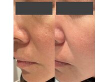 アズール 春日井店(AZURE)/プラズマ光フェイシャル