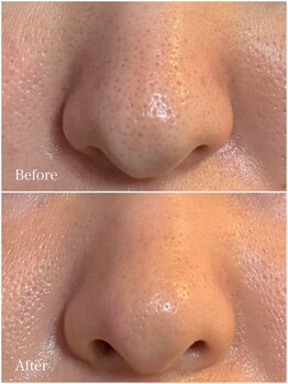 ブラン 名古屋高岳(BLANC)の写真/忙しい日々にご褒美を。効果重視の1day艶肌リセットで、くすみ・毛穴レスな発光美肌を手に入れる