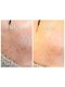 クラリス(Clarice)の写真/シミケア・イボケア・ホクロを機器で目立たなくします。お悩み解消する事で魅せるお肌に変わります。八王子