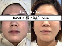 ディアメ(Diame)/大人気!! ReSKin/極上美肌☆