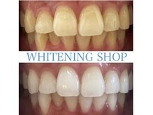 ホワイトニングショップ 天王寺店/10回ご来店後のお写真です