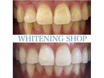 ホワイトニングショップ 天王寺店/10回ご来店後のお写真です