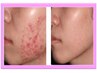 [顔]脱ステロイド【肌質改善美容鍼】皮膚の回復を高める施術  初回体験¥6980