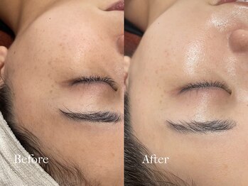 プレジール(plaisir)/毛穴ケア/ピーリング