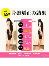 セレンディピティ 守山店(Serendipity)/45歳　骨盤矯正でダイエット成功