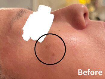 ダイヤモンド リーエンダ(Diamond leende)/クレイハーブピーリング