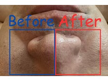 ユガミ(YUGAMI)/毛穴ケアコース6,000円～