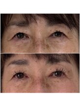 エステサロン ベルジュール/リフトアップ