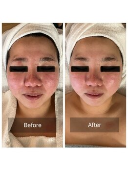 ミンク(Mink)/赤みを抑えて小顔に◎