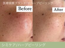 オーエン 小倉店(o-eN)/シミケア/ハーブピーリング