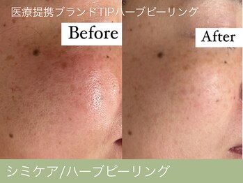 オーエン 小倉店(o-eN)/シミケア/ハーブピーリング