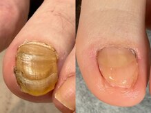 色が気になる爪も、ご相談ください！！