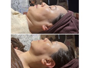 サリーエミリー 北千住店(SallyEmiry)/小顔コルギビフォーアフター