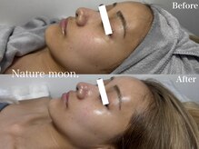 ナチュールムーン(Nature moon.)/ハーブピーリング