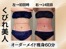 イヨヨ(iyoyo)/BeforeAfter　施術14回