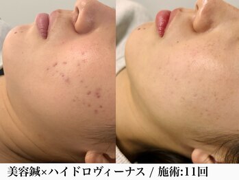 フラット(flat)/毛穴洗浄&美容鍼