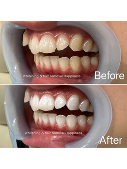 ハピネス 大阪梅田店(Happiness)/10分+13分+赤色20分/3回照射