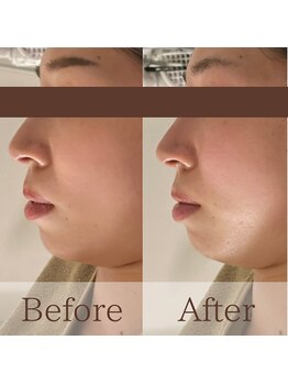 凪眠/小顔リンパフェイシャルの効果39