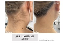 ミルク(MILC)/うなじ脱毛で年中きれいな姿に