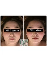 キュープ 小顔美容矯正専門サロン 横浜店(Qpu)/オイルコース12回の変化