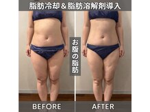 セターナルエス(Seternal.S)/脂肪冷却＆脂肪分解剤導入　