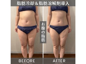 セターナルエス(Seternal.S)/脂肪冷却&脂肪分解剤導入