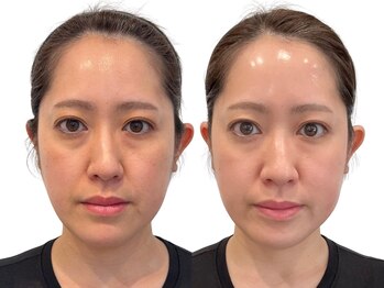 ココ(COCO)/口横たるみ/頬こけ/リフトアップ