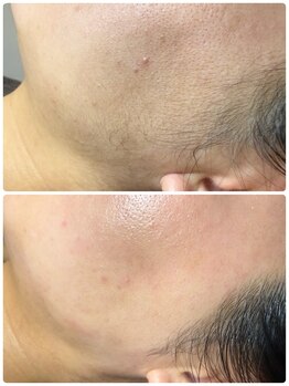 リンク(LINK.)/Face Wax Treatment