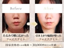 アロハ(ALOHA.)の雰囲気（一度で変化を実感。「あれっ痩せた？」と聞かれるフェイスライン）