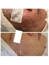 プランス 渋谷(PLANCE)/毛穴/ハーブ/ニキビケア