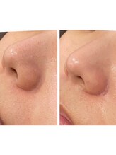 ライチャス(RAICHAS)/ハイドロフェイシャル