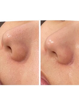 ライチャス(RAICHAS)/ハイドロフェイシャル