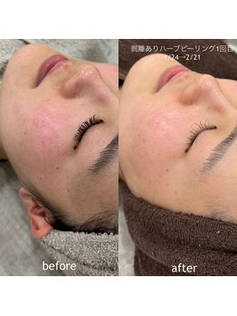 タグ 高知駅前店(Tug)/【頬の赤み・毛穴改善】剥離