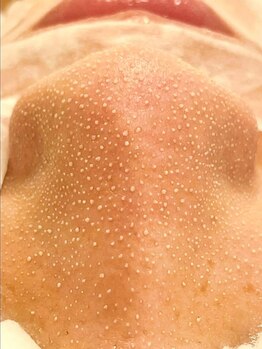 ヴォアール 富士宮店(VOIR)の写真/【ごっそり毛穴洗浄】長年の毛穴悩みから解放されたい貴方に！プロによる本気の毛穴洗浄をご体験ください★