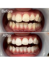 ハピネス 大阪梅田店(Happiness)/10分+13分+赤色20分/3回照射