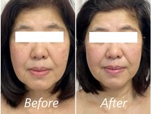 ドクターボディ 新宿店(Dr.Body)/【たるみ/面長/小顔　60代】