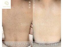 サロンドレナ 名駅店/ハーブピーリング サロンドレナ