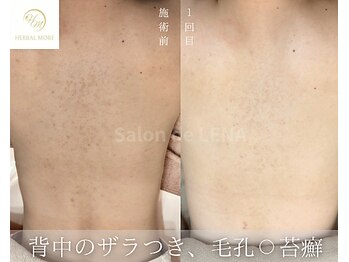 サロンドレナ 名駅店/ハーブピーリング サロンドレナ