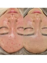 エン(en.)/ニキビケア.*