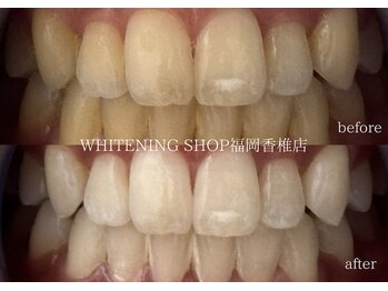 ホワイトニングショップ 福岡香椎店/美容ホワイトニングbefore after