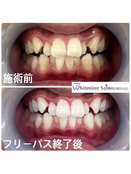 ホワイトニングサロン 京都烏丸店/ホワイトニング施術例