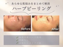 プレステージ 横須賀中央店の雰囲気（剥離なしハーブピーリング×2種のヒト幹細胞エクソソーム[毛穴]）