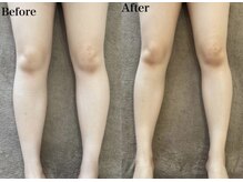 ミセル(MISEL2nd)/キープ力◎リピートNo.1最新痩身