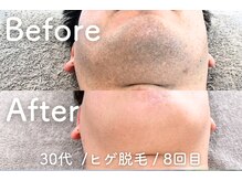 ユング 渋谷店(YUNG)/【ヒゲ脱毛】痛み抑制★冷却脱毛