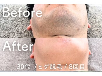 ユング 渋谷店(YUNG)/【ヒゲ脱毛】痛み抑制★冷却脱毛