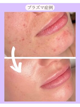 ホリホック/プラズマ症例