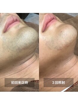 リムル(REMURU)/ひげ脱毛3回照射