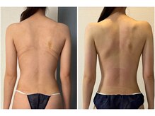 モア(moa)/3回目症例