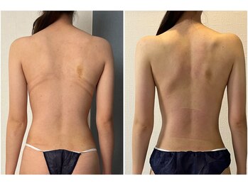 モア(moa)/3回目症例