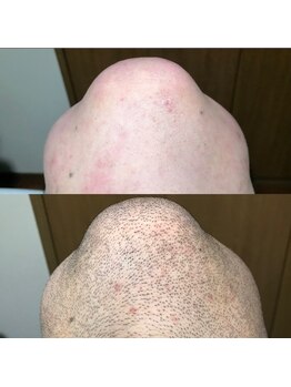 ナークス(NARX)/他脱毛店で効果が出なかった方◎